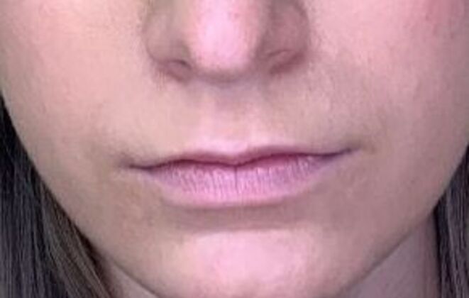 Filler Case 7 - Before