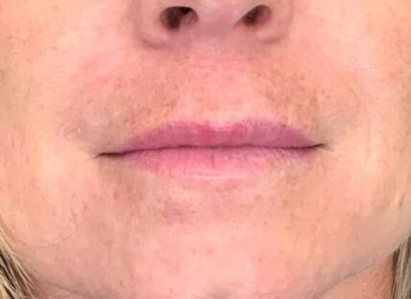 Filler Case 8 - After