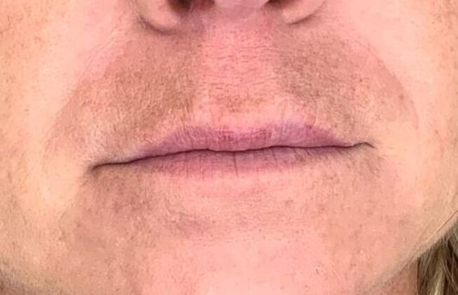 Filler Case 8 - Before