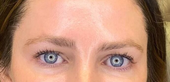 Filler Case 9 - After