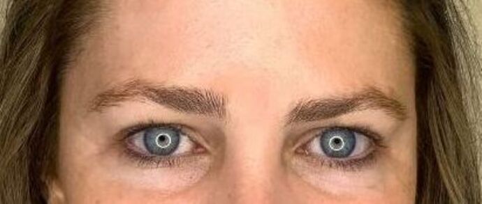 Filler Case 9 - Before