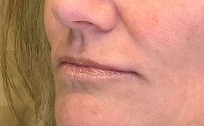 Filler Case 11 - Before