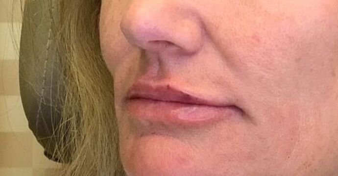 Filler Case 11 - After