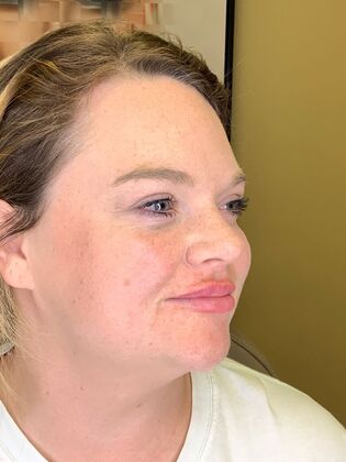 Filler: Case 12 - Before