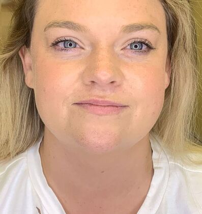 Filler Case 12 - Before