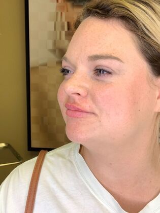 Filler: Case 12 - After