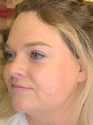 Filler: Case 12 - Before