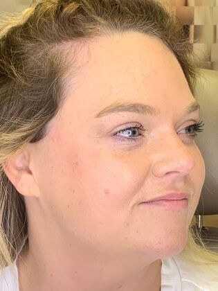 Filler: Case 12 - After