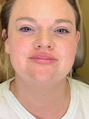 Filler Case 12 - After