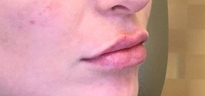 Filler: Case 13 - After