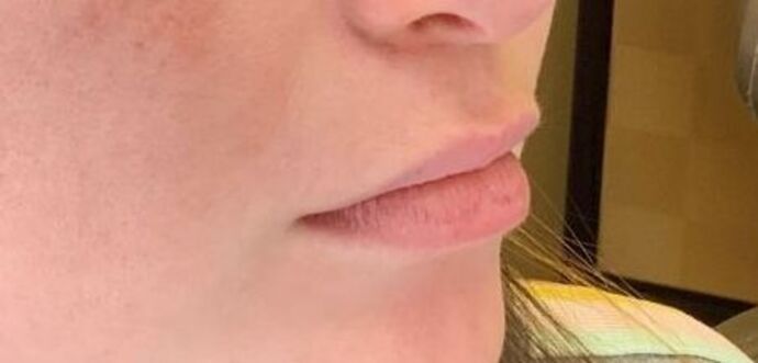 Filler: Case 13 - Before