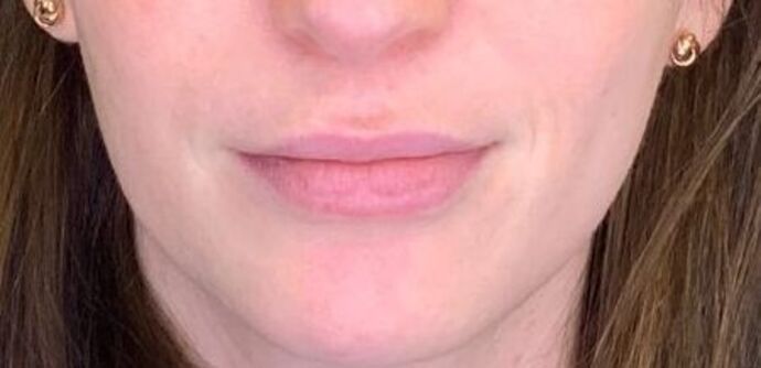 Filler Case 13 - Before