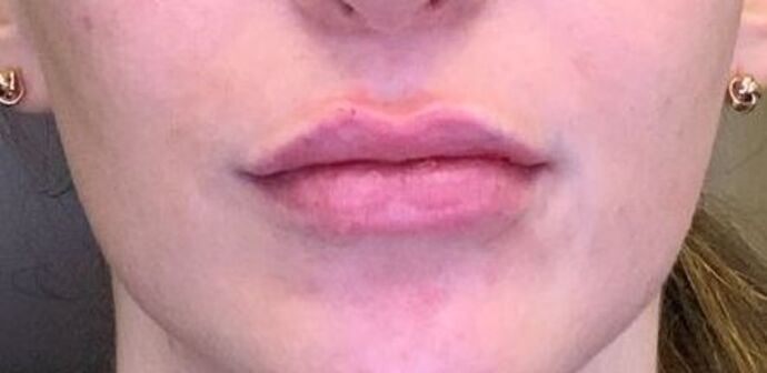 Filler Case 13 - After