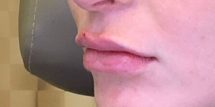 Filler: Case 13 - After