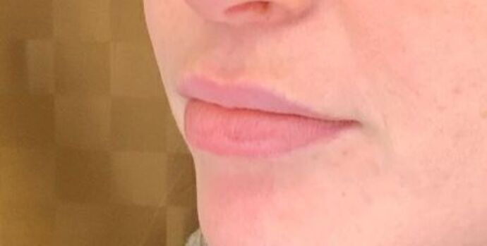 Filler: Case 13 - Before