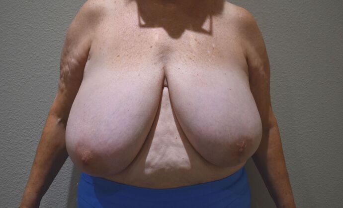 Breast Reduction Case 42 - Before