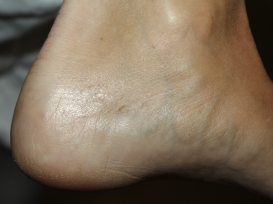 Laser Tattoo Removal Case 40 - After