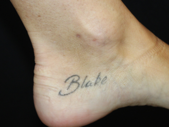 Laser Tattoo Removal Case 40 - Before