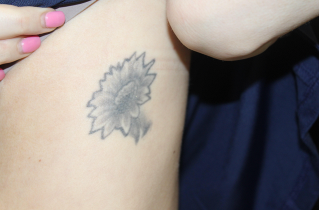 Laser Tattoo Removal Case 42 - Before