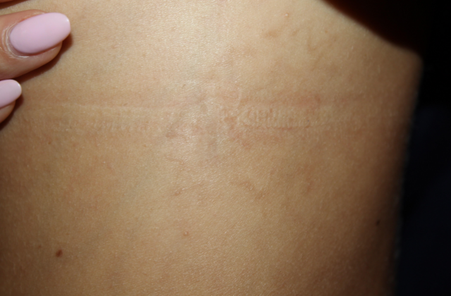 Laser Tattoo Removal Case 42 - After