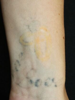 Laser Tattoo Removal Case 41 - Before