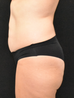 Abdominoplasty: Case 30 - Before