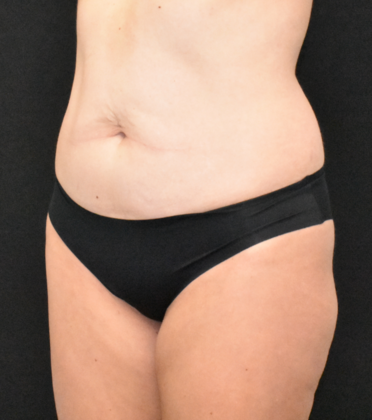 Abdominoplasty: Case 30 - Before