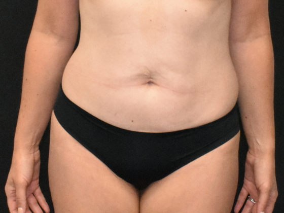 Abdominoplasty Case 30 - Before