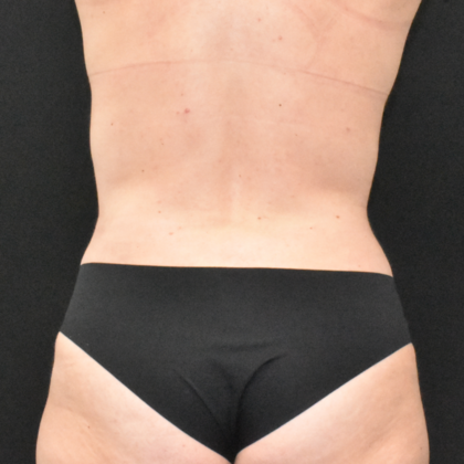 Abdominoplasty: Case 30 - After
