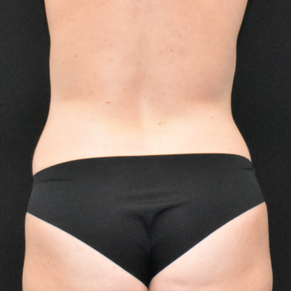 Abdominoplasty: Case 30 - Before
