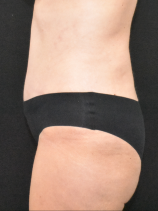 Abdominoplasty: Case 30 - Before
