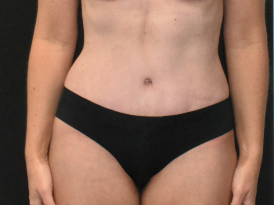 Abdominoplasty Case 30 - After