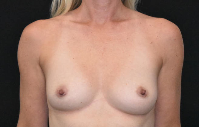 Breast Augmentation: Case 23 - Before