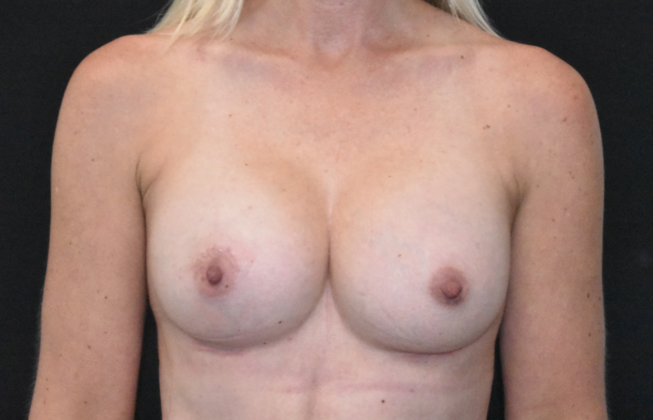 Breast Augmentation: Case 23 - After