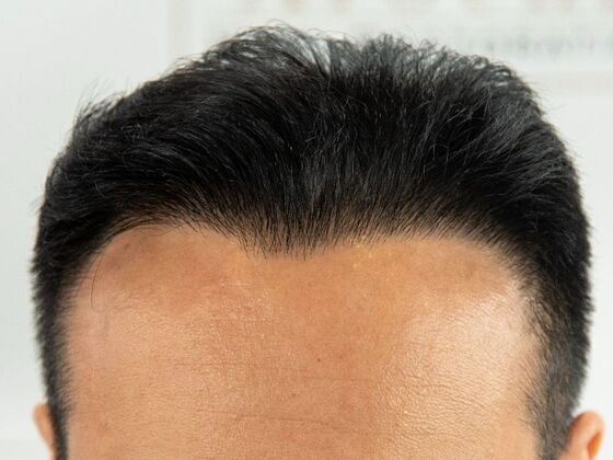 FUE Hair Restoration: Case 36 - After