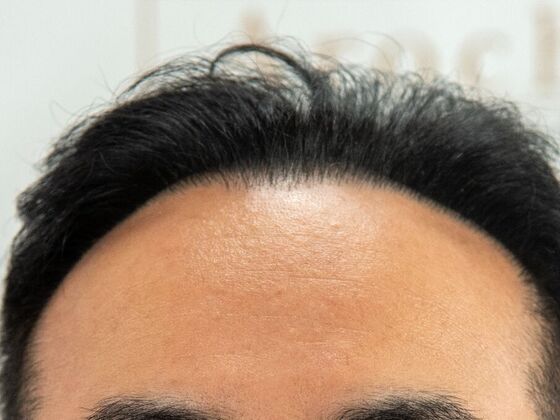 FUE Hair Restoration: Case 36 - Before
