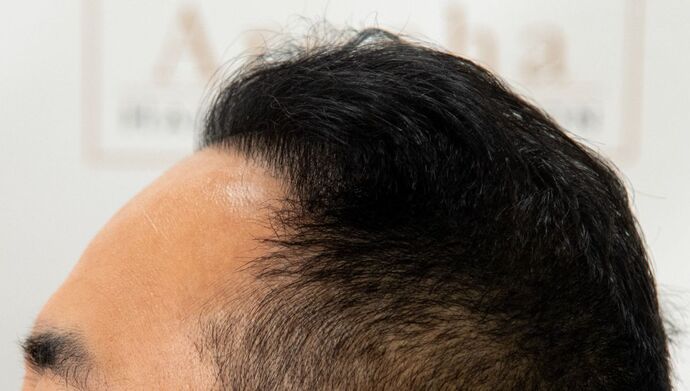 FUE Hair Restoration: Case 36 - After