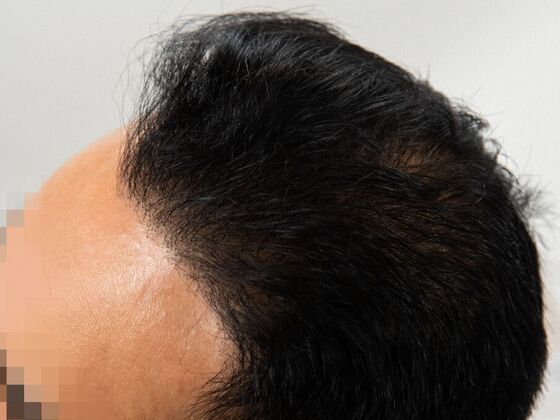 FUE Hair Restoration: Case 36 - After