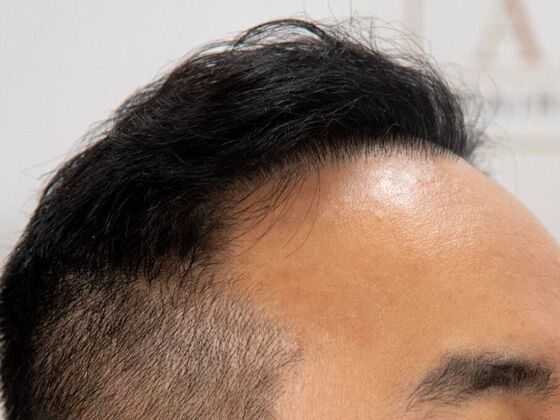 FUE Hair Restoration: Case 36 - After