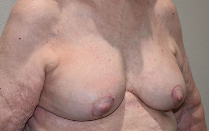 Breast Revision: Case 297 - After