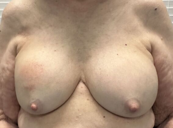 Breast Revision: Case 297 - Before