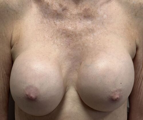Breast Revision: Case 300 - Before