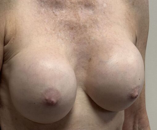 Breast Revision: Case 300 - Before