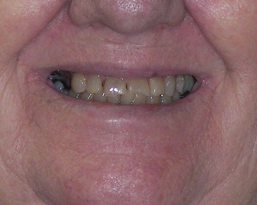 Dental Implants: Case 4 - Before
