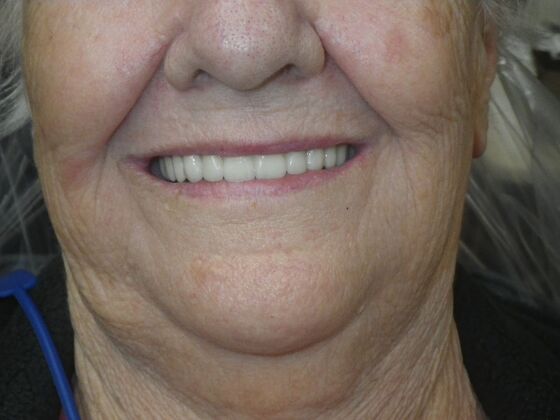 Dental Implants: Case 4 - After