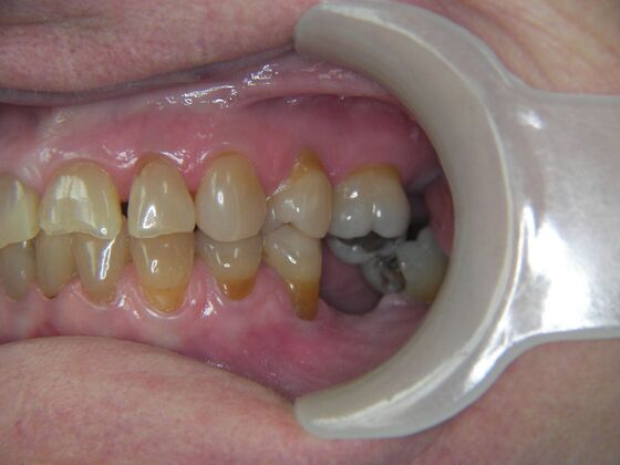 Dental Implants: Case 4 - Before