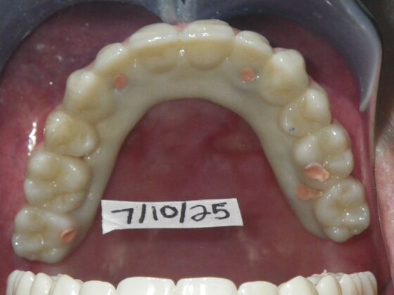 Dental Implants: Case 4 - After