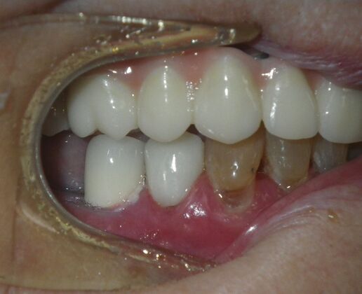 Dental Implants: Case 4 - After