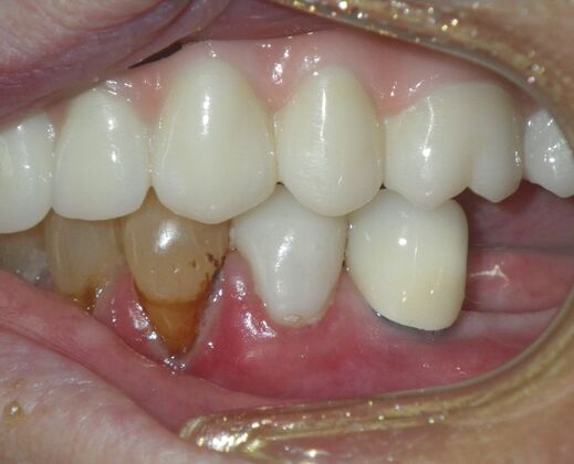 Dental Implants: Case 4 - After