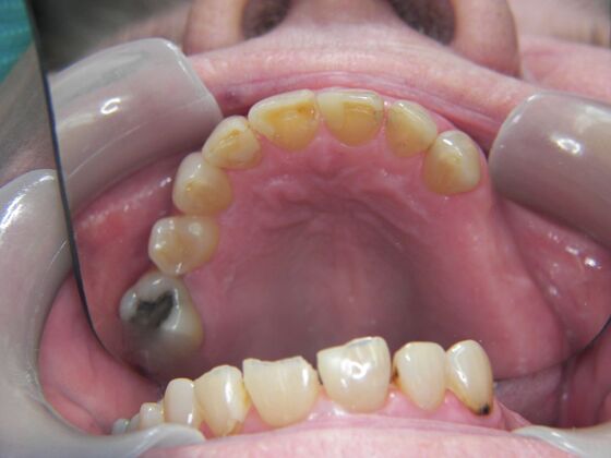 Dental Implants: Case 4 - Before